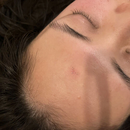 ほうれい線 なくす 美容鍼 恵比寿