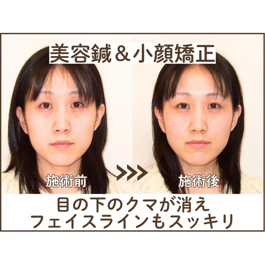 たるみ改善 リフトアップ 美容鍼 東京